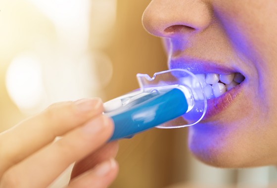 Best teeth whitening kit